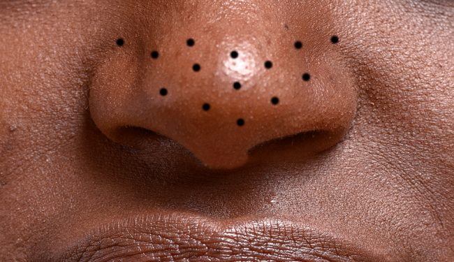 Get rid of blackheads on nose